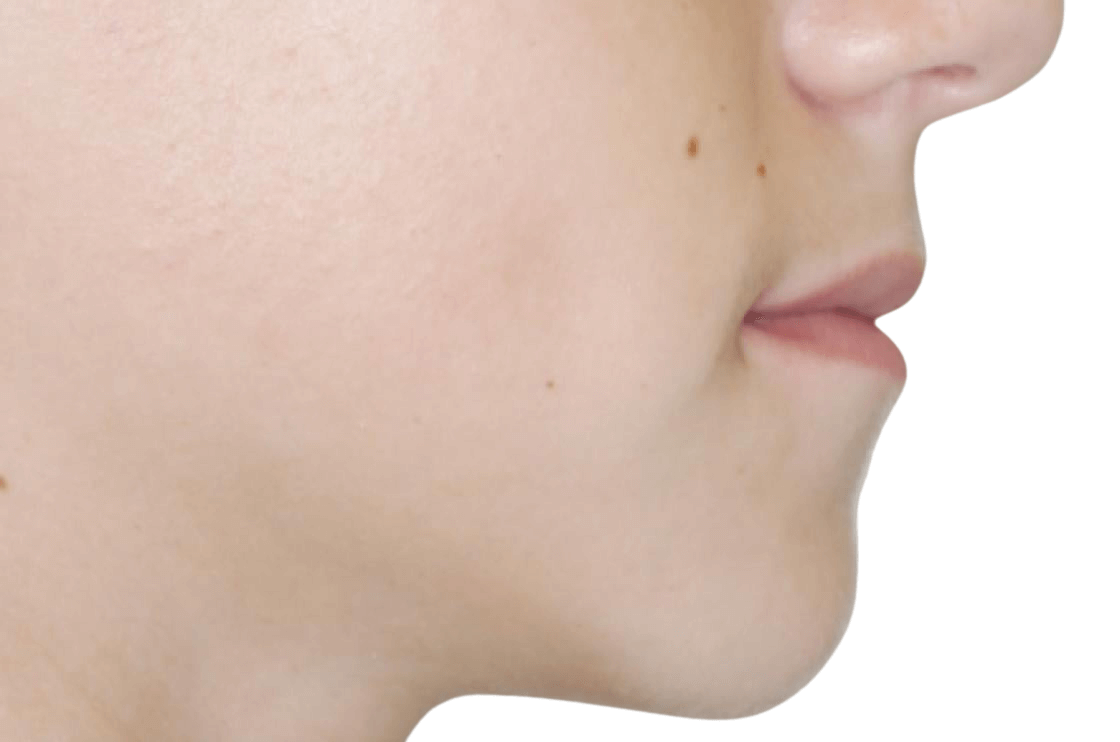 תמונה אחרי ניתוח לסתות