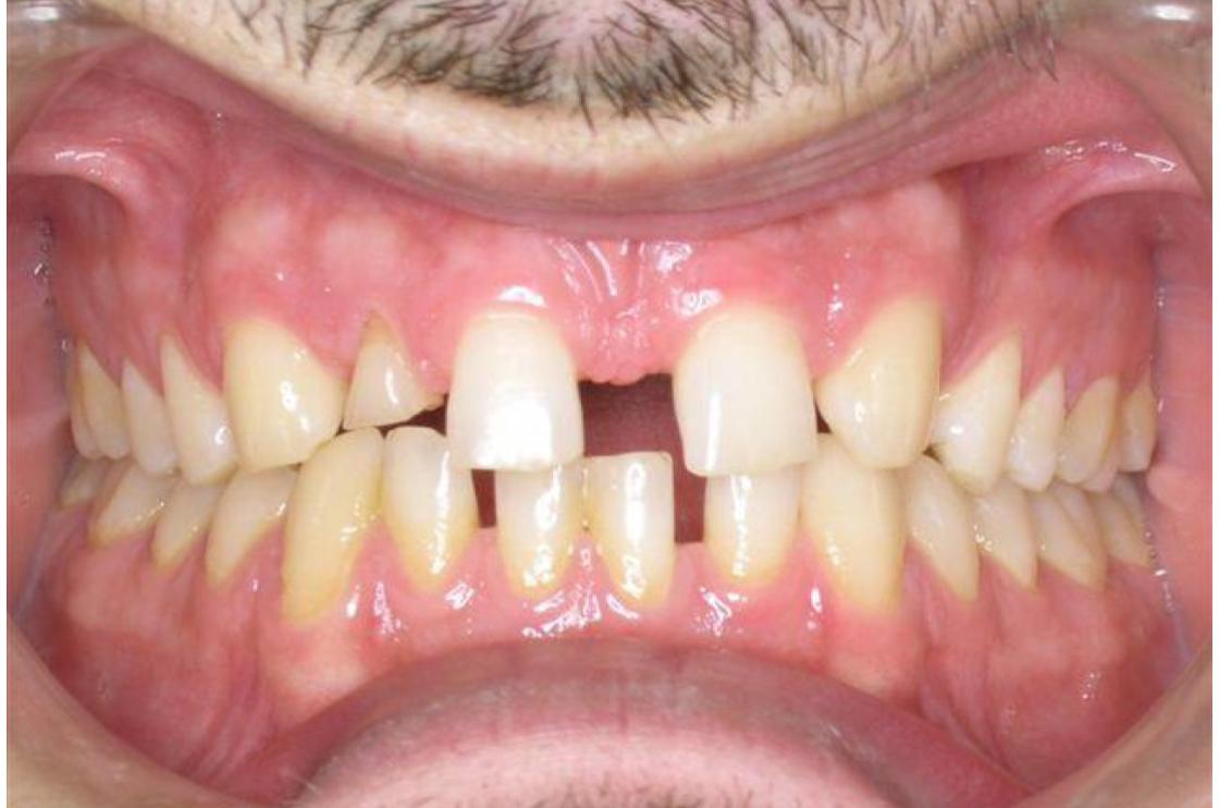 טיפול חסר שיניים - לפני ואחרי 2