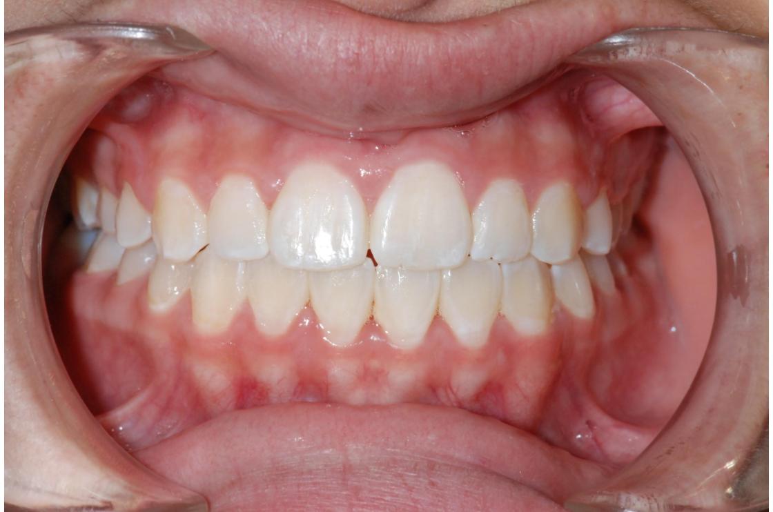 הפסקת מציצת אצבע - לפני ואחרי 1