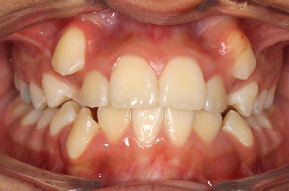 טיפול שיניים צפופות ללא עקירות - לפני ואחרי 2