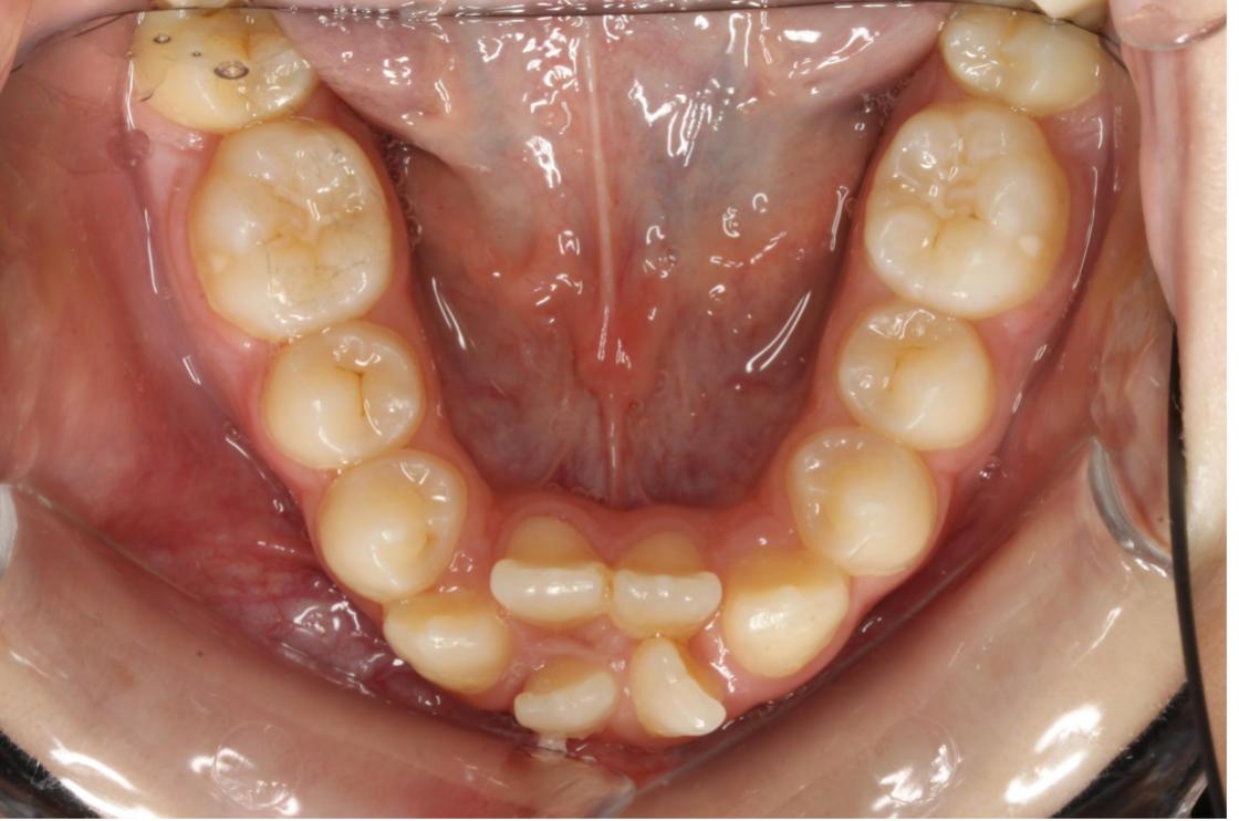 טיפול שיניים צפופות ללא עקירות - לפני ואחרי 4