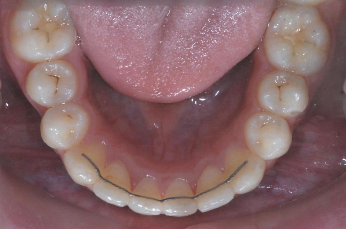 טיפול שיניים צפופות ללא עקירות - לפני ואחרי 3