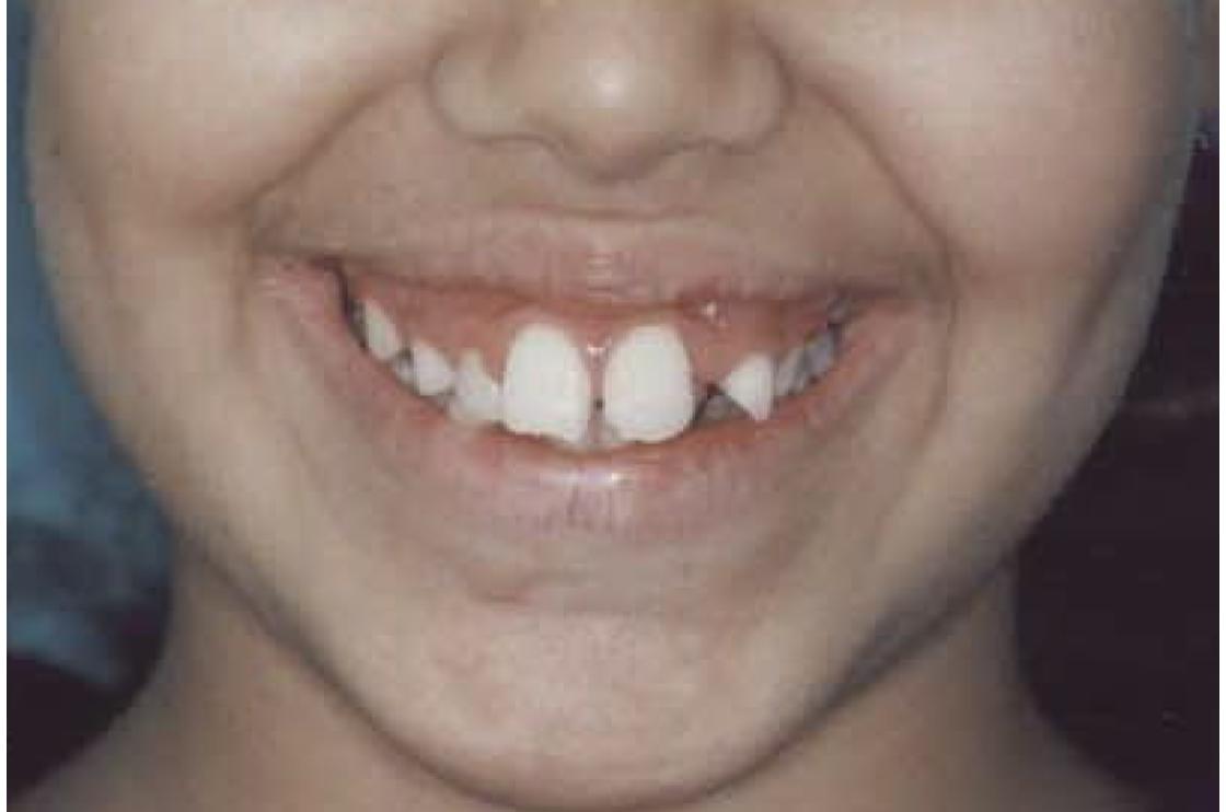 טיפול שיניים צפופות עם עקירות - לפני ואחרי 2