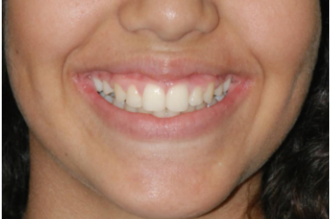 טיפול שיניים צפופות עם עקירות - לפני ואחרי 1