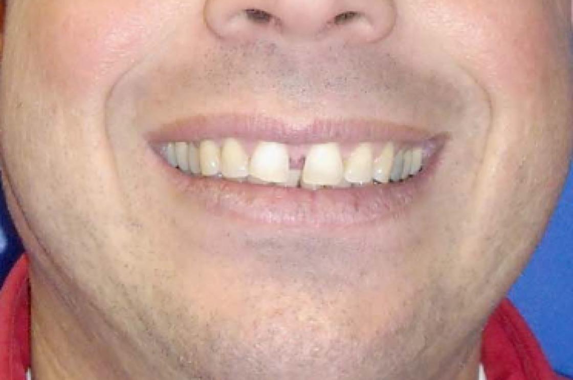 סגירת רווחים - לפני ואחרי 2