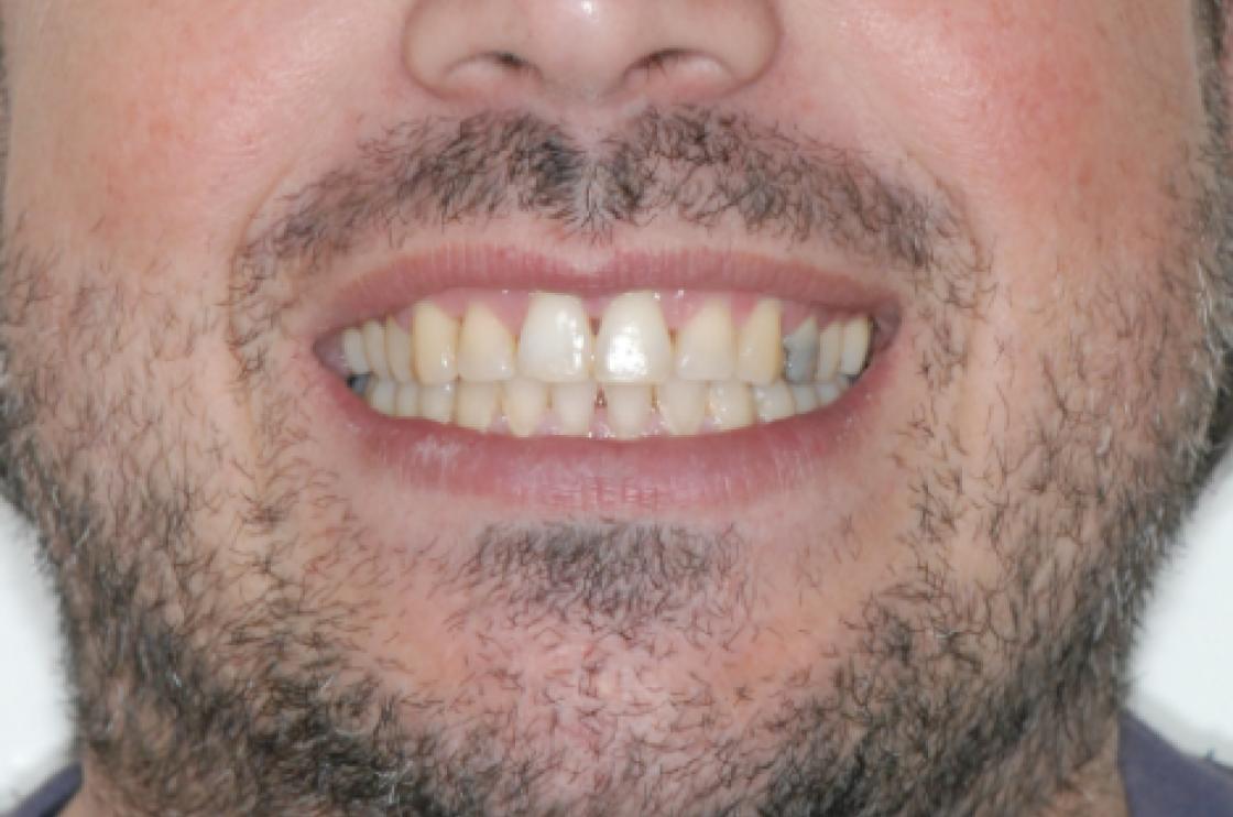 סגירת רווחים - לפני ואחרי 1